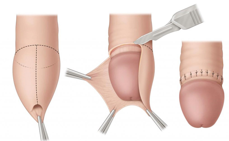Giới thiệu đôi nét về thủ thuật cắt bao quy đầu