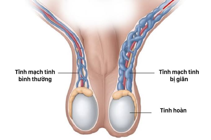 Siêu âm tinh hoàn giúp phát hiển ra những bệnh lý nào?