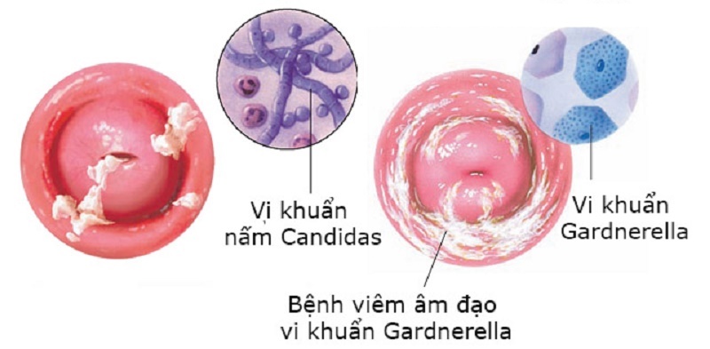 Các loại viêm âm đạo nữ giới nên cảnh giới