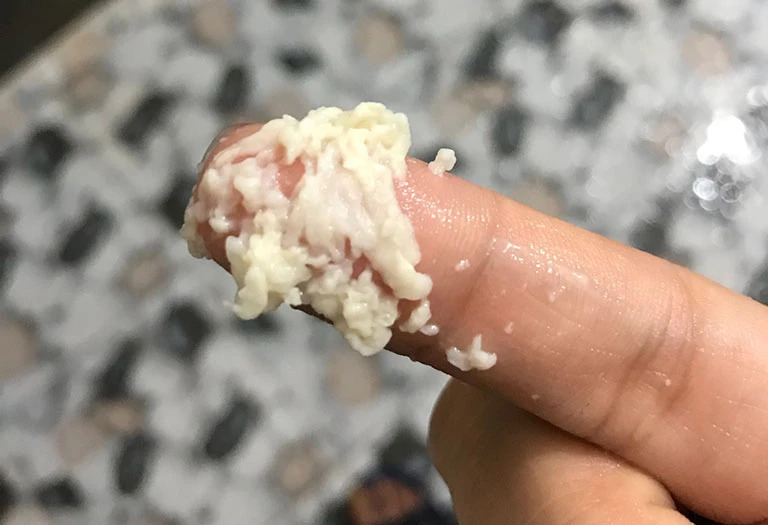 Khí hư trắng đục như bả đậu là dấu hiệu chị em bị nhiễm nấm Candida