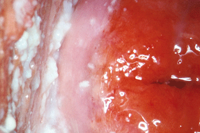 Nấm candida là nguyên nhân khiên khí hư đột nhiên ra nhiều