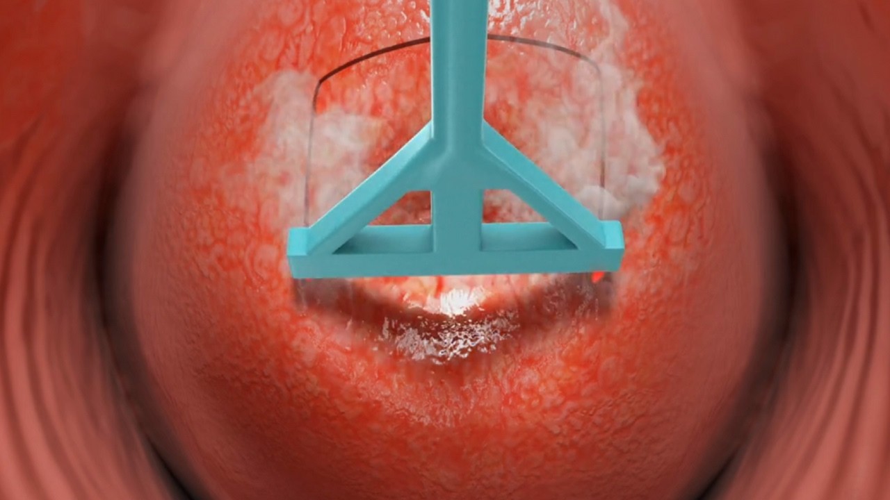 Phương pháp chữa trị khí hư bất thường ra nhiều
