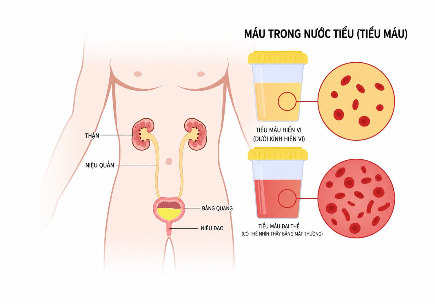 Tiểu máu nếu nhìn thấy được gọi là tiểu máu đại thể, ngược lại gọi là vi thể