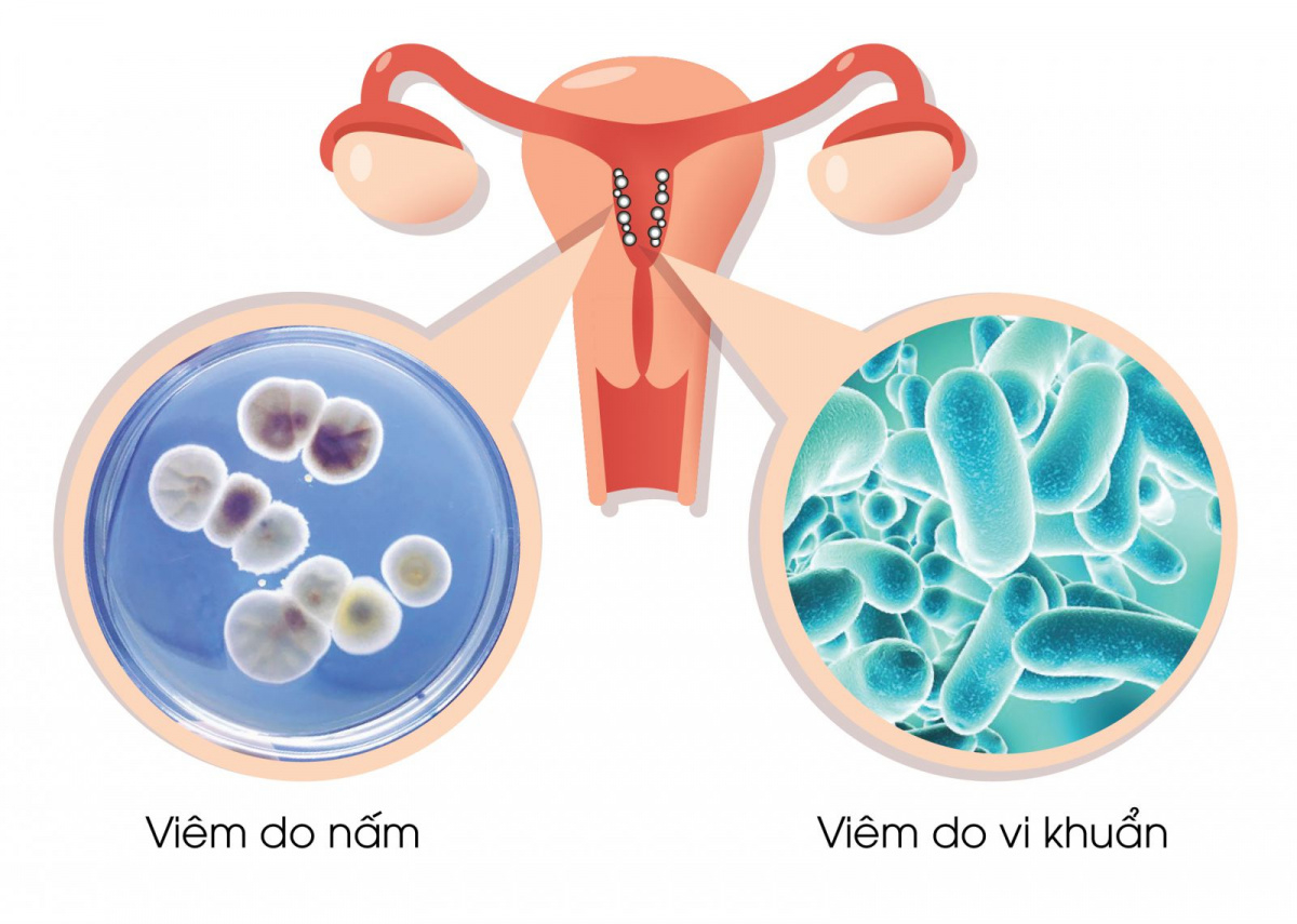 Tổng quan về bệnh viêm âm đạo ở nữ giới
